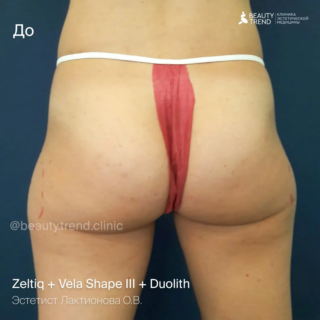 Zeltiq + Vela Shape III + Duolith, Лактионова - до 1